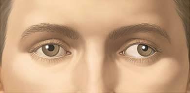 O estrabismo corresponde à perda do paralelismo entre os olhos.