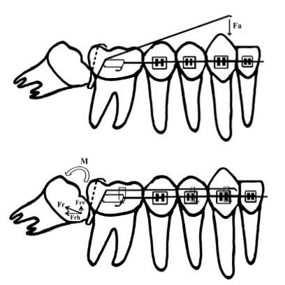REVISTA GESTÃO & SAÚDE (ISSN 1984-8153) 6 Figura 3: Fa, força atuando sobre o braço mesial do cantilever; Fr, força reciproca atuando sobre o molar impactado; Frv (vertical) componente extrusivo; Frh