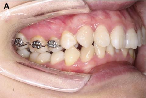 REVISTA GESTÃO & SAÚDE (ISSN 1984-8153) 7 Figura 4: Aplicação de técnica ortodôntica para racionamento do molar inferior.