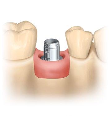 Excelente retenção através de indexação exclusiva Flexibilidade através de duas alturas de margem disponíveis Encaixe preciso devido a interface implante-pilar ser original