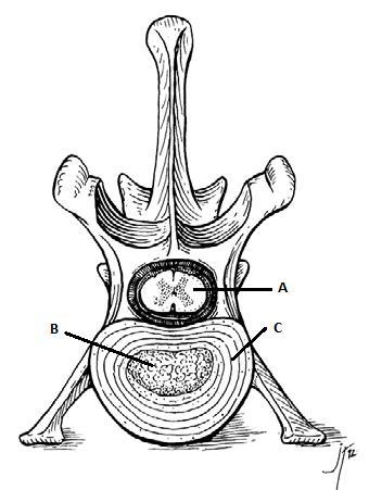 18 largo, portanto é resistente à herniação de material nuclear dorsalmente, muitas vezes desviando-o lateralmente em direção às raízes nervosas espinhais (TOOMBS; BAUER, 1993).