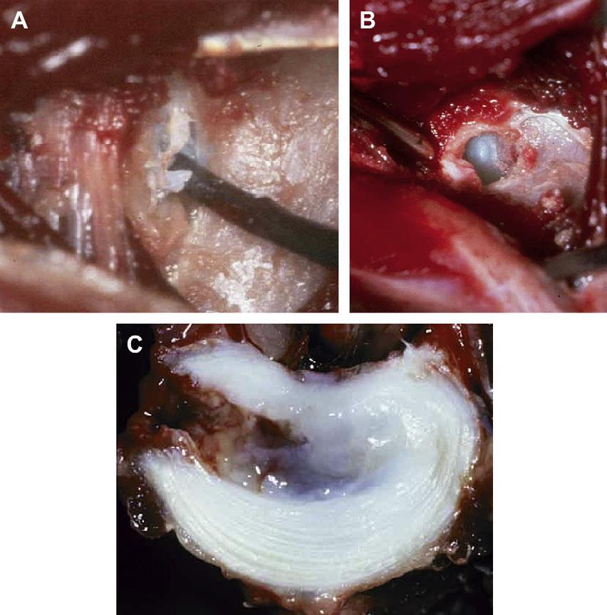 Figura 20- Espaço do disco durante (A) e após (B) fenestração cirúrgica através de uma abordagem de dorsolateral