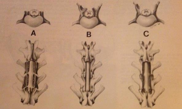 63 HAMAIDE, 2016). A fibrose constritiva não é um problema nesta técnica, mas o acesso cirúrgico ao canal vertebral é limitado.