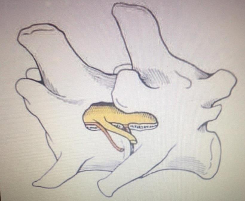 Figura 24- Ilustração da região lombar após submissão a técnica de pediculolectomia. Pode-se verificar a preservação dos processos articulares das vértebras adjacentes. 67 Fonte: Fossum, T. W. (2007).