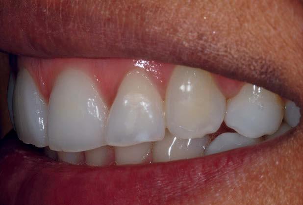 anatômicos dos dentes anteriores.
