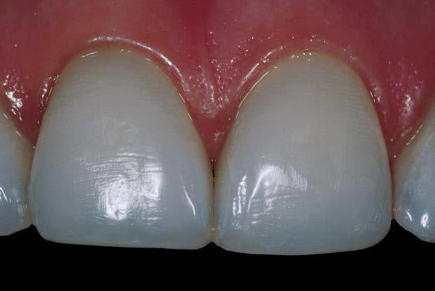 Figura 15 - Vista frontal dos dentes