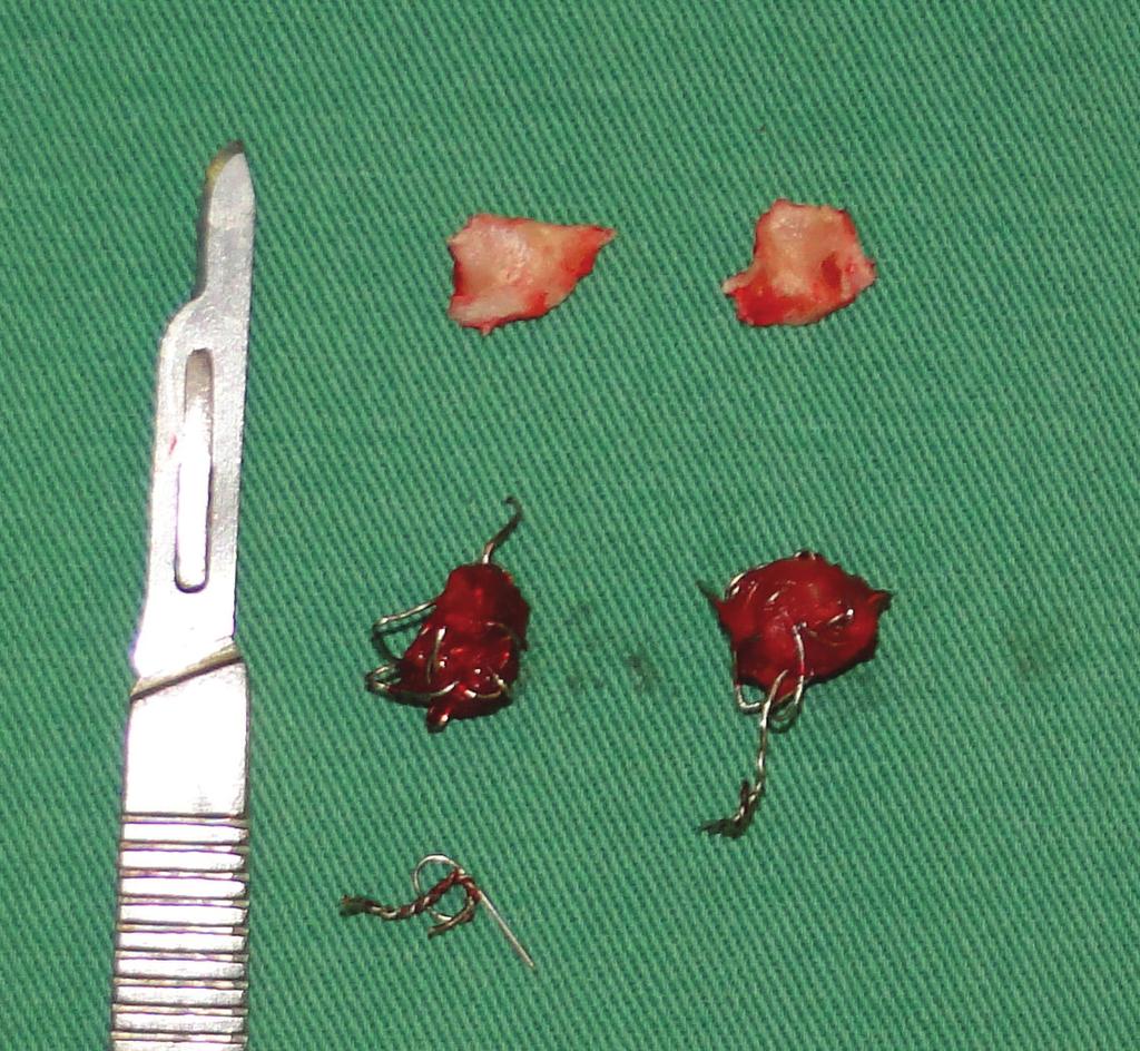 Em seguida, sutura interna com fio reabsorvívele sutura contínua da pele na região temporal e intradérmica na região pré-auricular.