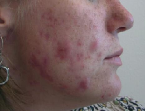 14 FIGURA 1: Paciente adulta com acne nodulocística afetando o queixo e linha da mandíbula, tendo também pápulas, pústulas e comedões.