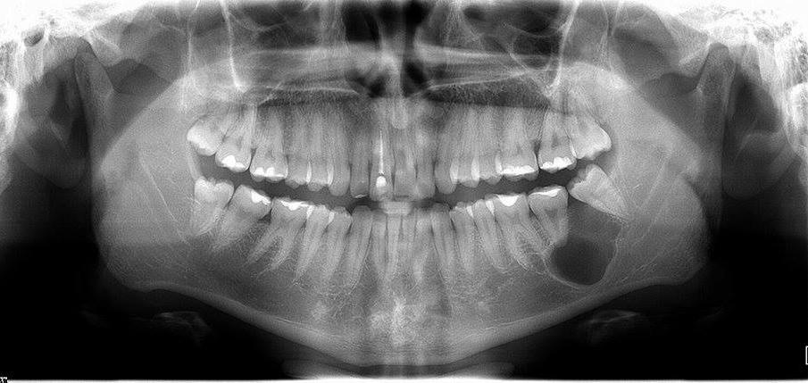 limites macroscópicos do tumor, para melhor acesso e ressecção das margens11 e o acompanhamento pós-operatório com exames de imagem são essenciais, uma vez que apresentam altos índices de recidiva.