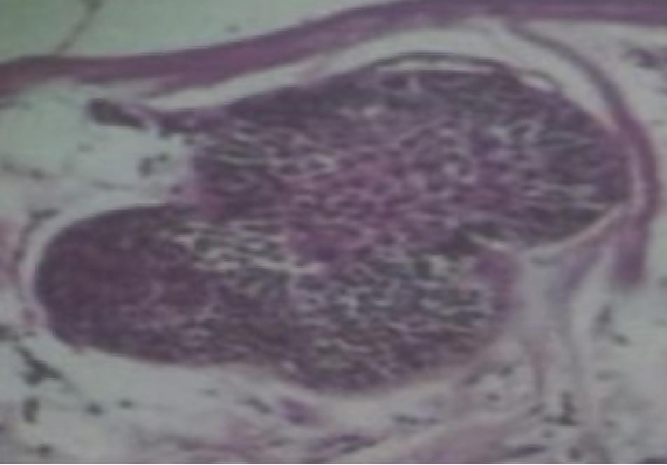 Com base na anamnese e nos dados obtidos nos exames de imagem e anatomopatológico, o diagnóstico para o caso foi de Ameloblastoma Unicístico. Figura 4 e 5. Figura 6.