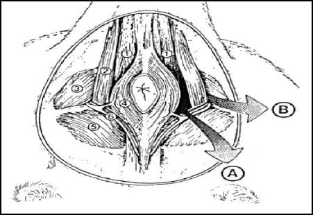 15 Figura 2. Relação anatômica de períneo normal (Lado direito) a de uma hérnia perineal.