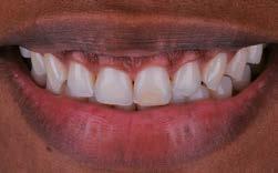 REESTABELECENDO A ESTÉTICA COM RESTAURAÇÃO DE RESINA COMPOSTA ANTERIOR A abordagem menos invasiva para fratura coronária envolvendo esmalte e dentina não complicada é a colagem
