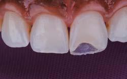 Esta primeira camada tem como objetivo restituir o contorno palatinoincisal do dente. A partir daí, pode-se proceder à estratificação de dentro para fora.