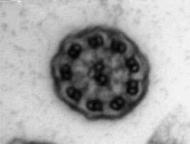 Fig. 2 Ausência de braços internos e externos de dineína (microscopia electrónica).