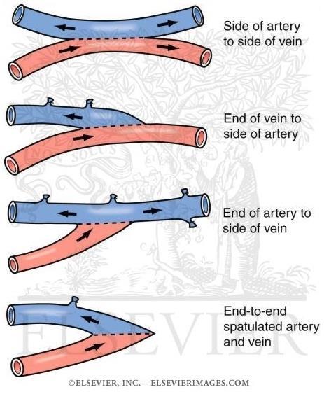 Anastomoses União entre dois ramos arteriais ou duas veias.