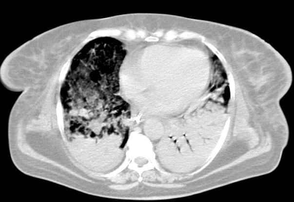 Introdução - 9 Até mesmo pacientes sem nenhum tipo de lesão pulmonar aguda, quando submetidos à anestesia geral para cirurgias eletivas e analisados pela TC de tórax, apresentam colapso nas porções