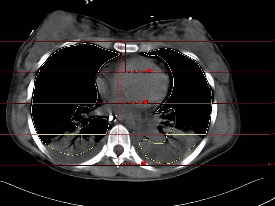 Casuística e Métodos - 22 pulmonar.