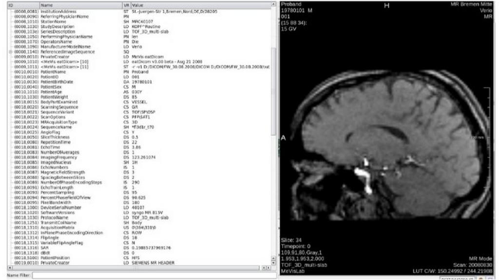 Tomografia Computadorizada A TCAR está se tornando prática padrão no diagnóstico de DPIs; Permite a visualização