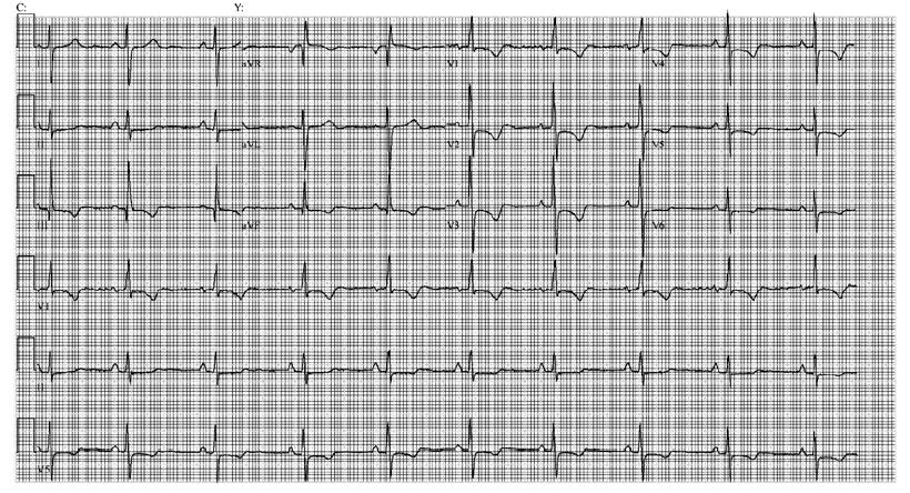 27 O electrocardiograma (ECG) do doente com TEP pode apresentar taquicardia sinusal, flutter ou fibrilhação auricular recente, padrão S1Q3T3, infradesnivelamento do segmento ST em DII, padrão de