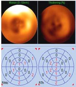 32 Figura 7 Mapa polar da avaliação semiquantitativa do grau de espessamento e motilidade de um paciente do estudo após terapia de ressincronização.