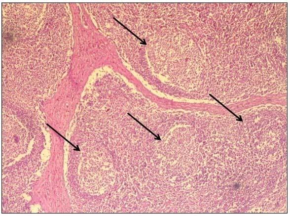 Figura 1. Frequência dos estágios de lesões encontrados nos linfonodos inguinais de suínos clinicamente sadios. (SLS - sem lesão significativa) Figura 2.