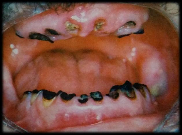 14 É de grande relevância o acompanhamento dental através de consultas odontológicas a cada 6 meses para verificar a existência de cárie e preservação da saúde bucal (SROUSSI et al., 2017).