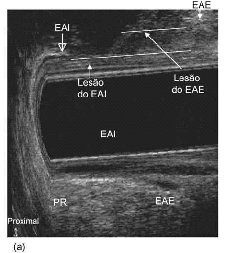 Defeito anatômico do EAE Defeito anatômico do EAE (a) do canal anal (b) do canal anal