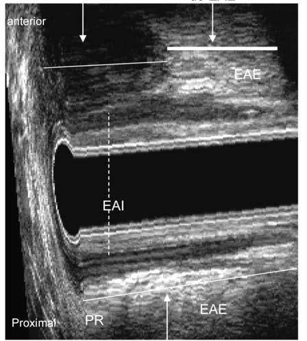 PR-puborretal FIGURA 2 Lesões musculares; a-lesão EAE e EAI anterior, proximal-distal.