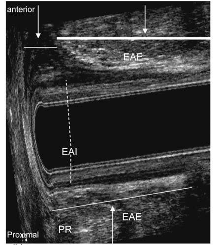 Corte transversal posterior-anterior; medidas do comprimento longitudinal das lesões