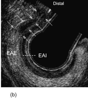Corte sagital com diagonal; EAI-esfincter anal interno, EAE-esfincter anal externo, PR-puborretal (três com comprimento médio de 2,2 cm e um abscesso extenso em todo o comprimento do canal anal com