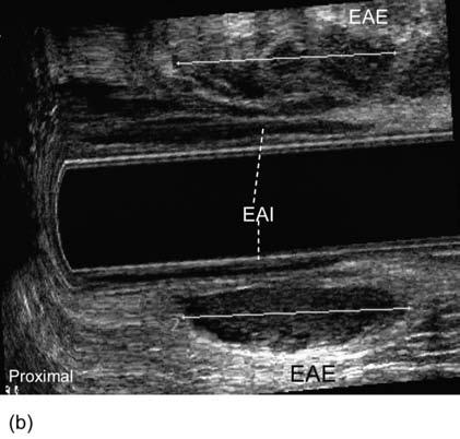 TABELA 2 - Resultados do ultra-som Ultra-som endoanal Lesão esfincteriana 11 Fístula anal 8 Abscesso 7 Endometriose retal 1 Cisto pré-sacral 1 Neoplasia no canal anal 3 Neoplasia no reto 10 Normais