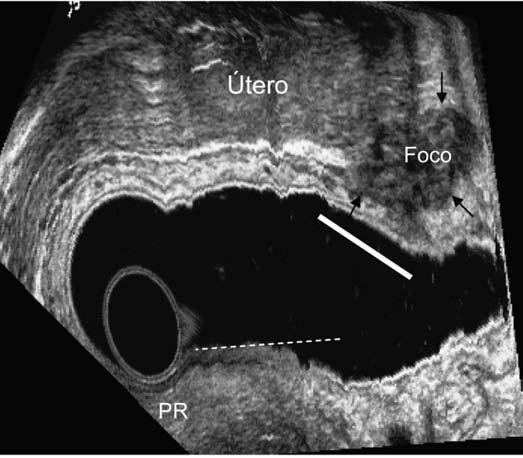 FIGURA 5 Foco de endometriose no corpo do útero invadindo a parede do reto (muscular própria)no quadrante ântero-lateral esquerdo (setas).