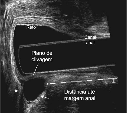 PR- puborretal, EAI-esfincter anal interno FIGURA 6 Cisto pré-sacral (setas) DISCUSSÃO A avaliação clínica e proctológica completa associada ao claro entendimento do complexo anatômico que