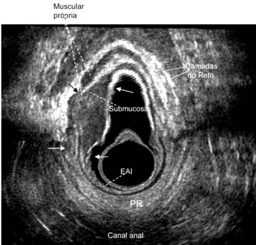das FIGURA 8 Neoplasia no reto- ut3; a-foco de invasão na gordura perirretal (seta). Confirma no corte longitudinal. Medidas da extensão da lesão:comprimento (1) e profundidade (2).