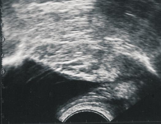 fina) e HPB. A B Figura 11: Exame ultra-sonográfico da próstata de um cão de 8 anos de idade com HPB, sem sinais clínicos. A. Imagem longitudinal, onde as setas delimitam a próstata (P) e B é a bexiga.