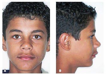 19 3.1.3 PADRÃO III Fig.4A, B - Deficiência mandibular. Fonte: Dental Press Ortodon Ortop. Facial, 2008.