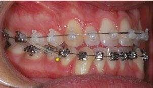 pré-molares inferiores. O paciente apresentava um perfil reto.
