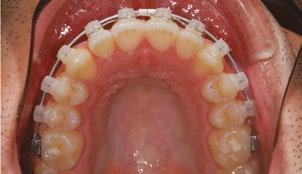 Os primeiros elásticos utilizados foram 3/8 9.53mm 8 oz e posteriormente foram utilizados ¼ 6,4mm 61/2 oz.