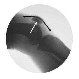 A partir de 56 graus de flexão do joelho até a extensão máxima, a força do quadríceps é maior do que a força de contato patelofemoral.