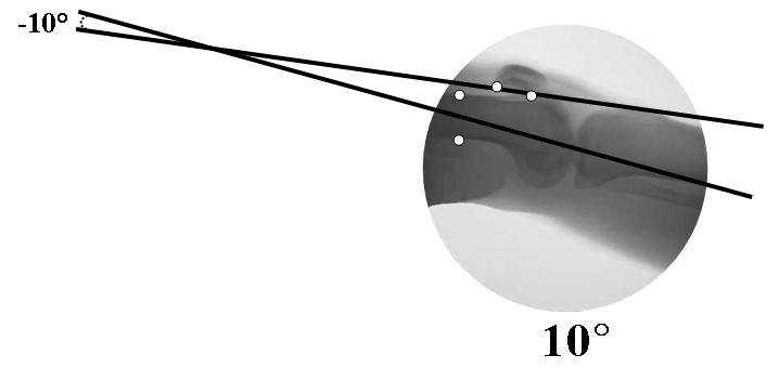 92), observou-se um aumento do tilt ântero-posterior com o aumento da flexão do joelho, conforme pode ser observado, esquematicamente, na Figura 38.
