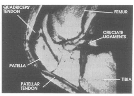 27 Figura 2 Imagem da articulação patelofemoral, sem lesão articular, no plano sagital, obtida por meio de ressonância nuclear magnética. Fonte: Gill & O Connor (1996).