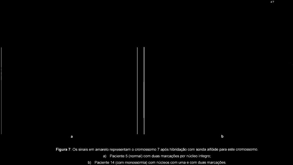 a) Paciente 5 (normal) com duas marcações por núcleo integro;