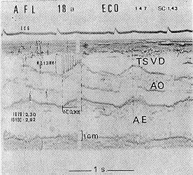 TSDV = trato de saída do ventrículo direito. AE = átrio esquerdo. ECG = eletrocardiograma.