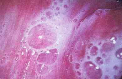 3) Diagnóstico: Através da coleta de urina de primeiro jato e analise em por microsopia (o parasita tem aspecto e