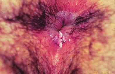 11verrugas na vulva e pênis Câncer HPV16, 18, 31 e 45