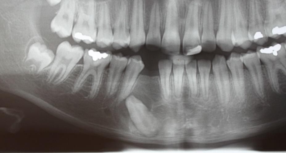 11 Figura 2.2: Radiografia panorâmica após 8 meses da remoção da lesão, apresentando cicatrização óssea na região acima do canino inferior direito incluso.