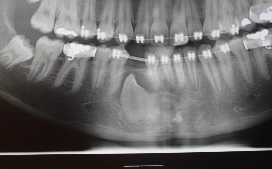 erupção do elemento dentário, como também a formação de uma camada mais fina de osso cicatrizado acima do dente (Figura 2.3).