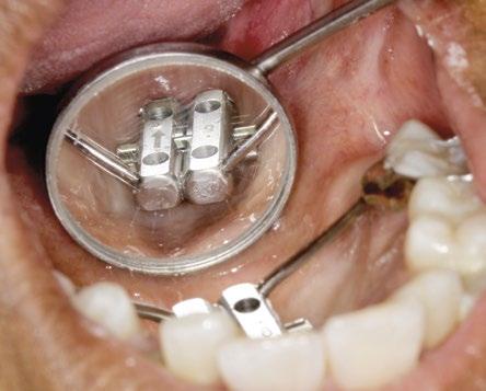 O torno deve ficar completamente paralelo ao palato do indivíduo para evitar o desnivelamento do plano oclusal com a ativação do disjuntor (Figura 10).