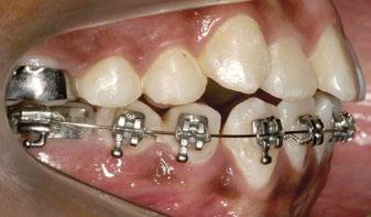 Discussão Aparelhos dentossuportados e dentomucossuportados não promovem a ERM com disjunção puramente esquelética, especialmente nos