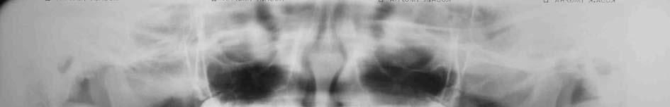 45 Figura 5 - Radiografia panorâmica 15 x 30 cm.